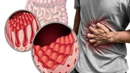 تأثیر تغذیه مناسب در کنترل و بهبود بیماری سلیاک